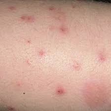 Image result for flea bites