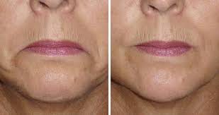 Botox before and after pictures mouth. Grumpy Downward Mouth Lines Treatment With Botox Auckland
