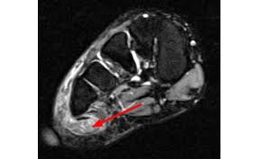 Lumbricals of foot are multiple small muscles that contribute biomechanical balance of the foot during walking. Baxter S Nerve Entrapment Diagnosis Treatment Injection Surgery