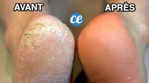 Une cloque aux pied est douloureuse et très handicapante, voyons comment la traiter sans douleur et de manière naturelle… on vous dit tout ! Toutes Les Astuces Sur Pieds