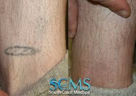 Whether it is for professional purposes, to remove symbols of your past, or to correct an artistic change of heart, there is no one reason that people come to gentlecare laser aesthetics for tattoo removal. Orange County Laser Tattoo Removal Orange County Laser Tat Flickr