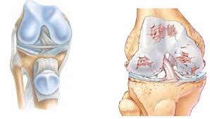 L'arthrose est la forme d'arthrite la plus commune. Arthrose