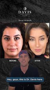 Buccal fat removal treatment results. #davisfacialplastics #drpatrickdavis  #beverlyhillsplasticsurgeon