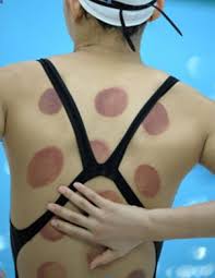 Dec 12, 2019 · the bruises for cupping can last for a few days up to two weeks. Have A Stubborn Injury Cupping Therapy May Help