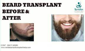 Beard Hair Transplant Treatments In India Facial Hair Transplant Treatments Beard Transplant Facial Hair Transplant Facial Hair Growth