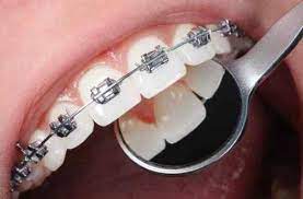 Cheap Fake Braces
