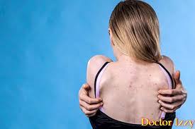 Sebagian besar benjolan di leher belakang tidak berbahaya dan dapat sembuh atau hilang dengan sendirinya. Cara Menghilangkan Jerawat Di Bahagian Belakang