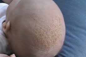 Image result for sores on the head in children