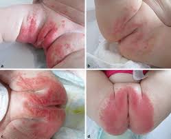 Image result for diaper dermatitis