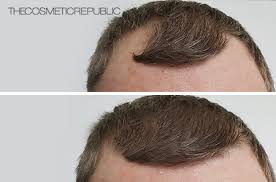 Elastic hair ties can grip hair too tightly and cut into the hair shaft, causing fraying when they are repeatedly used in the same spot. How To Hide Thinning Hair At The Front