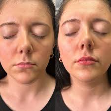 Created some lippies for this cutie!! 🫦😍 We used 1 syringe of Restylane  Refyne…focusing mostly