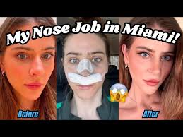 My AWAKE Rhinoplasty Experience in MIAMI: Was it worth it? + SURGEON REVEAL 