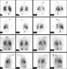 Image result for Ventilation Perfusion Scan