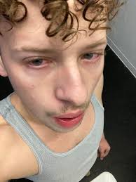 Does glycerol cause stomach issues?