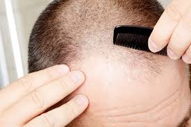 Are there any side effects of using nizoral? Can Ketoconazole Shampoo Dandruff Shampoo Regrow Hair