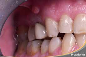 Fistula En La Encia Que Es Y Tratamiento De La Fistula Dental
