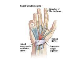 Pinpoint your symptoms and signs with medicinenet's symptom. Tingling In Your Fingers Is It Carpal Tunnel Or Something Else Sheltering Arms
