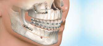 We specialize in the complex treatment of oral surgery cases, and are experts in procedures such as wisdom teeth, tooth extractions, dental implants, all on four, tmj. Best Oral Maxillofacial Surgeons Premier Hospital