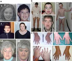 Cohen Syndrome Causes Symptoms Diagnosis Treatment Prognosis