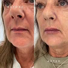 Laser Pigmentation Removal