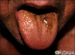 Image result for brown tongue symptoms
