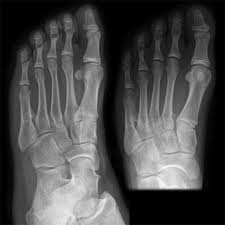 People of all races and colors get melanoma on their feet. Osteochondroma Radiology Reference Article Radiopaedia Org