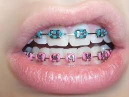 29 Horrible Things That Happen When You Put Your Retainer In For The First Time In Forever Pink Braces Getting Braces Cute Braces