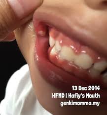 Selepas 10 hingga 12 hari dijangkiti, pesakit mula kena demam suhu tinggi, sakit otot, batuk, selsema, sakit tekak. Tanda Tanda Anak Terkena Jangkitan Hfmd Genkimomma My