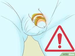 Please avoid scrubbing the incision site. How To Clean A Circumcision 15 Steps With Pictures Wikihow Mom