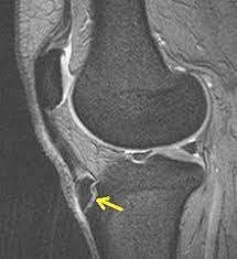Morbus Osgood Schlatter Wikipedia