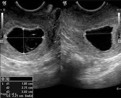 Pregnancy Of Uncertain Viability Radiology Reference Article Radiopaedia Org