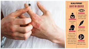 Tujuan utama tatalaksana penyakit lupus/sle. 7 Perkara Tentang Penyakit Autoimun Sle Lupus Tiroid Psoriaris