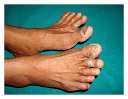 Image result for Clubbing nails feet