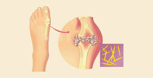 Image result for Hyperuricemia