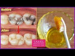 Help prevent tooth decay & future dental work. 3 à®¨ à®Ÿ à®•à®³ à®² à®ªà®± à®š à®¤ à®¤ à®¨ à®™ à®• à®‡à®¤ à®¤ à®¤à®µ à®° à®µ à®± à®®à®° à®¨ à®¤ à®‡à®² à®² Tamil Beauty Tips Youtube Good Health Tips Cavity Treatment Natural Health Tips