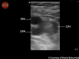 Posts about rush exam written by sonospot. Pocus Rush Protocol International Emergency Medicine Education Project