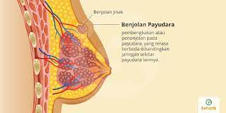 Dalam dunia kesehatan, sakit pada payudara dikenal dengan istilah medis mastalgia. Benjolan Payudara Tanda Dan Gejala Penyebab Cara Mengobati Cara Mencegah