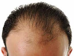 Genetic hair loss is the only hair loss in which the follicle gradually gets smaller and finer and producers smaller and finer hair until it stops altogether and then you get the thinning, says lyons. Frontal Hair Loss How To Treat And Prevent Frontal Hair Loss Hair Loss Treatment Hair Loss Therapy
