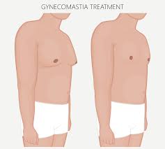 Image result for Gynecomastia