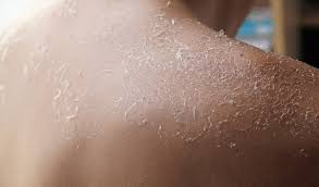 How To Prevent Sunburn From Peeling | Tiege Hanley