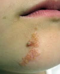 Image result for verrucae filiformes