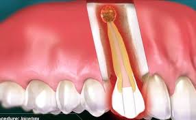 How long does it take to perform a root canal. How Long Does A Root Canal Take Houston Dentist Dr J Explains