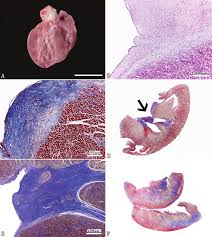 Image result for Restrictive Cardiomyopathy