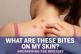 Image result for bedbug bites look like