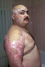 L'accident d'irradiation à Forbach (1991)