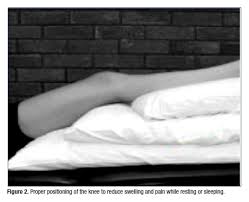 Your decision about surgery for a torn meniscus will depend on where the tear is located, the pattern of the tear, and how big it is. Pain Management After Acl Surgery