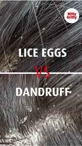 Image result for lice vs dandruff