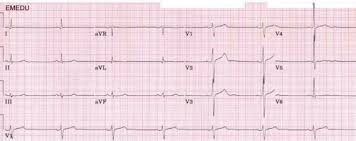 Acls Pre Test Part 2 - Practical Application Flashcards | Quizlet