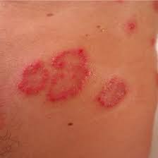 Cel mai adesea, petele roșii de pe picioare sunt asociate cu astfel de cauze: Pitiriazis Versicolor Apare Frecvent Pe Piept Si Spate