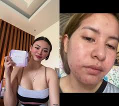 #duet with @Jewelle Jingco Tan #adornbycalmskin grabeee 🥹💜🫶🏻  #camilletrinidad #rejuvenation